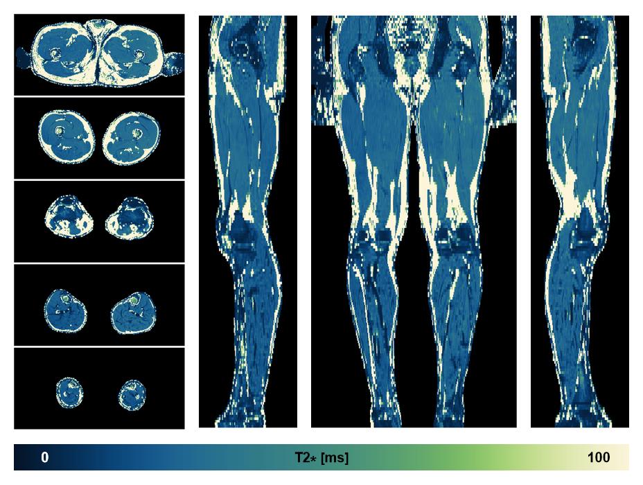 The T2 star relaxation time of the lower extremity obtained from the dixon reconstruction for muscle water fat quantification.